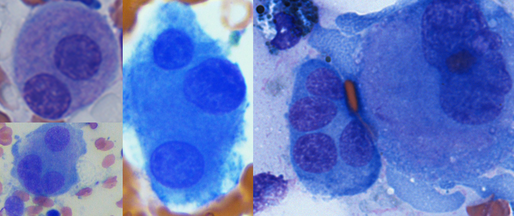 Bone marrow aspirate: dysplastic megakaryocytes